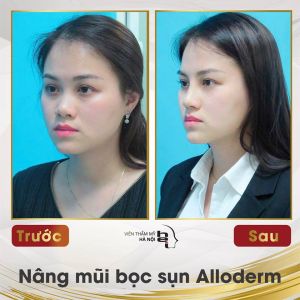 Hình ảnh nâng mũi trước sau Bs Mai Mạnh Tuấn – Ca 3