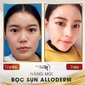 Hình ảnh nâng mũi trước sau Bs Mai Mạnh Tuấn – Ca 4