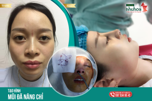 Hình ảnh nâng mũi Bs Tống Hải - Ca 1