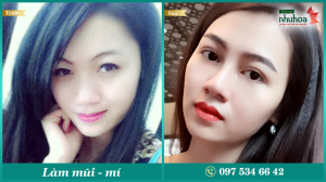 Hình ảnh nâng mũi & nhấn mí Bs Tống Hải - Ca 3