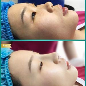 Hình ảnh nâng mũi Bs Tống Hải - Ca 4