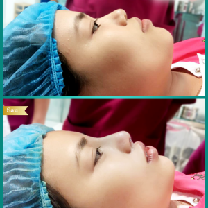 Hình ảnh nâng mũi Bs Tống Hải - Ca 5