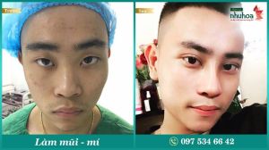 Hình ảnh nâng mũi & nhấn mí Bs Tống Hải - Ca 6