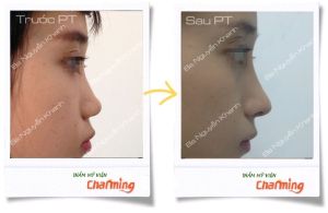 Hình ảnh nâng mũi cấu trúc Bs Nguyễn Khanh - Ca 18