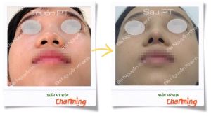 Hình ảnh nâng mũi cấu trúc Bs Nguyễn Khanh - Ca 18