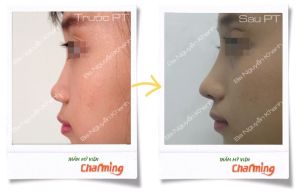 Hình ảnh nâng mũi cấu trúc Bs Nguyễn Khanh - Ca 18