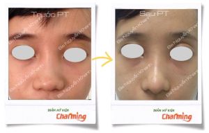 Hình ảnh nâng mũi cấu trúc Bs Nguyễn Khanh - Ca 18