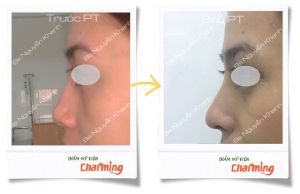 Hình ảnh nâng mũi cấu trúc Bs Nguyễn Khanh - Ca 19