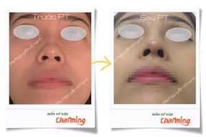 Hình ảnh nâng mũi cấu trúc Bs Nguyễn Khanh - Ca 19