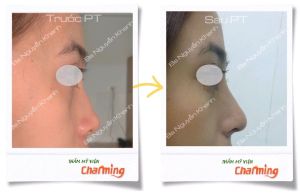 Hình ảnh nâng mũi cấu trúc Bs Nguyễn Khanh - Ca 19