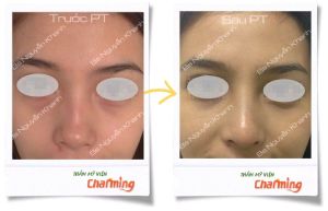 Hình ảnh nâng mũi cấu trúc Bs Nguyễn Khanh - Ca 19