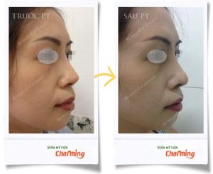 Hình ảnh sửa lại mũi đã nâng bs Nguyễn Khanh - Ca 20