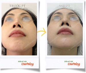 Hình ảnh sửa lại mũi đã nâng bs Nguyễn Khanh - Ca 20