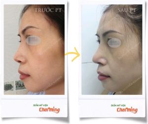 Hình ảnh sửa lại mũi đã nâng bs Nguyễn Khanh - Ca 20