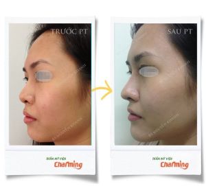 Hình ảnh nâng mũi cấu trúc Bs Nguyễn Khanh - Ca 21