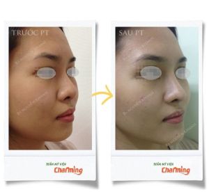 Hình ảnh nâng mũi cấu trúc Bs Nguyễn Khanh - Ca 21