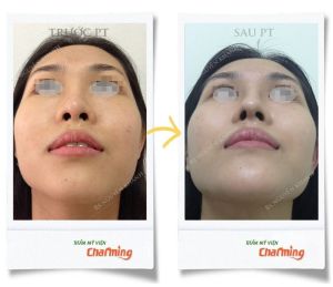 Hình ảnh nâng mũi cấu trúc Bs Nguyễn Khanh - Ca 21