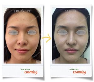 Hình ảnh nâng mũi cấu trúc Bs Nguyễn Khanh - Ca 21