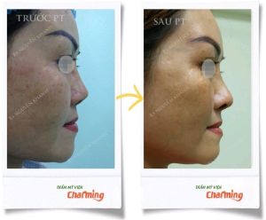 Hình ảnh nâng mũi cấu trúc Bs Nguyễn Khanh - Ca 22