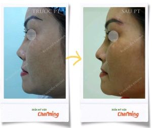 Hình ảnh nâng mũi cấu trúc Bs Nguyễn Khanh - Ca 22