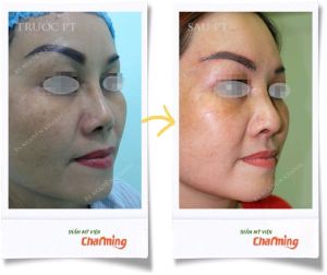 Hình ảnh nâng mũi cấu trúc Bs Nguyễn Khanh - Ca 22