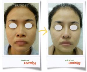 Hình ảnh nâng mũi cấu trúc Bs Nguyễn Khanh - Ca 23