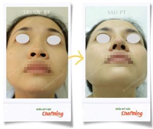 Hình ảnh nâng mũi cấu trúc Bs Nguyễn Khanh - Ca 23