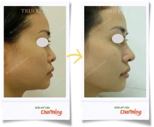 Hình ảnh nâng mũi cấu trúc Bs Nguyễn Khanh - Ca 23