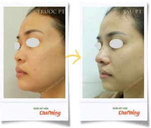 Hình ảnh nâng mũi cấu trúc Bs Nguyễn Khanh - Ca 23