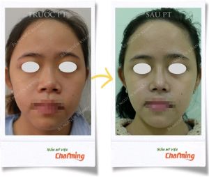 Hình ảnh nâng mũi cấu trúc Bs Nguyễn Khanh - Ca 24