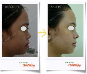 Hình ảnh nâng mũi cấu trúc Bs Nguyễn Khanh - Ca 24