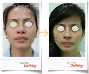 Hình ảnh nâng mũi cấu trúc Bs Nguyễn Khanh - Ca 25