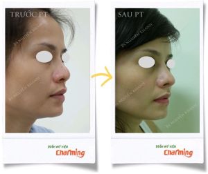 Hình ảnh nâng mũi cấu trúc Bs Nguyễn Khanh - Ca 25