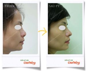 Hình ảnh nâng mũi cấu trúc Bs Nguyễn Khanh - Ca 25