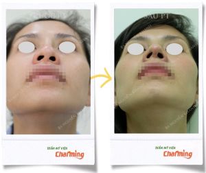 Hình ảnh nâng mũi cấu trúc Bs Nguyễn Khanh - Ca 25