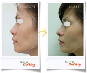 Hình ảnh nâng mũi cấu trúc Bs Nguyễn Khanh - Ca 25