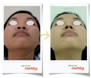 Hình ảnh nâng mũi cấu trúc Bs Nguyễn Khanh - Ca 26