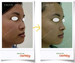 Hình ảnh nâng mũi cấu trúc Bs Nguyễn Khanh - Ca 26