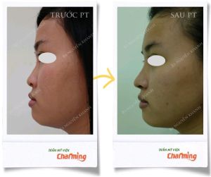 Hình ảnh nâng mũi cấu trúc Bs Nguyễn Khanh - Ca 26