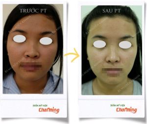 Hình ảnh nâng mũi cấu trúc Bs Nguyễn Khanh - Ca 26