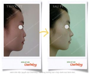 Hình ảnh nâng mũi cấu trúc Bs Nguyễn Khanh - Ca 27