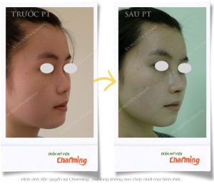 Hình ảnh nâng mũi cấu trúc Bs Nguyễn Khanh - Ca 27