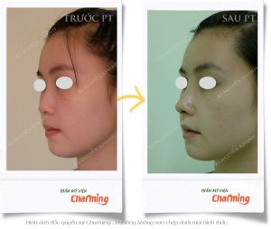 Hình ảnh nâng mũi cấu trúc Bs Nguyễn Khanh - Ca 27