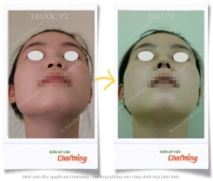 Hình ảnh nâng mũi cấu trúc Bs Nguyễn Khanh - Ca 27