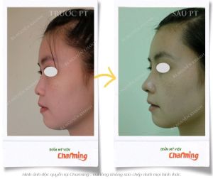 Hình ảnh nâng mũi cấu trúc Bs Nguyễn Khanh - Ca 27