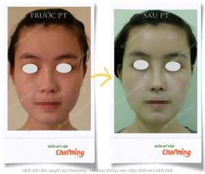 Hình ảnh nâng mũi cấu trúc Bs Nguyễn Khanh - Ca 27