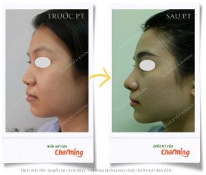 Hình ảnh nâng mũi cấu trúc và cắt cánh mũi sau 3 tuần - Ca 28