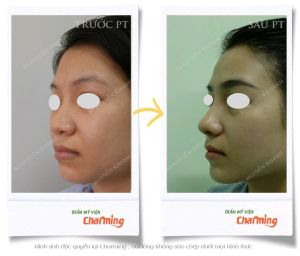 Hình ảnh nâng mũi cấu trúc và cắt cánh mũi sau 3 tuần - Ca 28