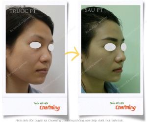 Hình ảnh nâng mũi cấu trúc và cắt cánh mũi sau 3 tuần - Ca 28