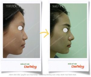 Hình ảnh nâng mũi cấu trúc và cắt cánh mũi sau 3 tuần - Ca 28